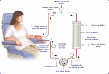 esquema de hemodiálisis
